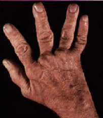 Reumatoide artritis