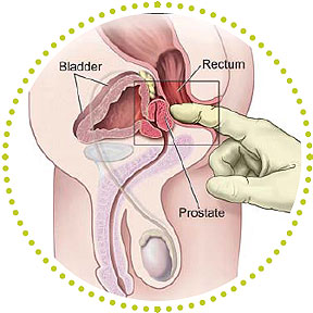 Prostaatkanker - rectaal onderzoek